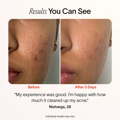 Bye Acne: 3-Minute Pimple Spot Treatment